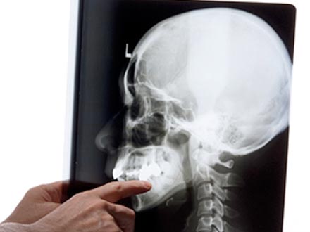 Articulació temporomandibular